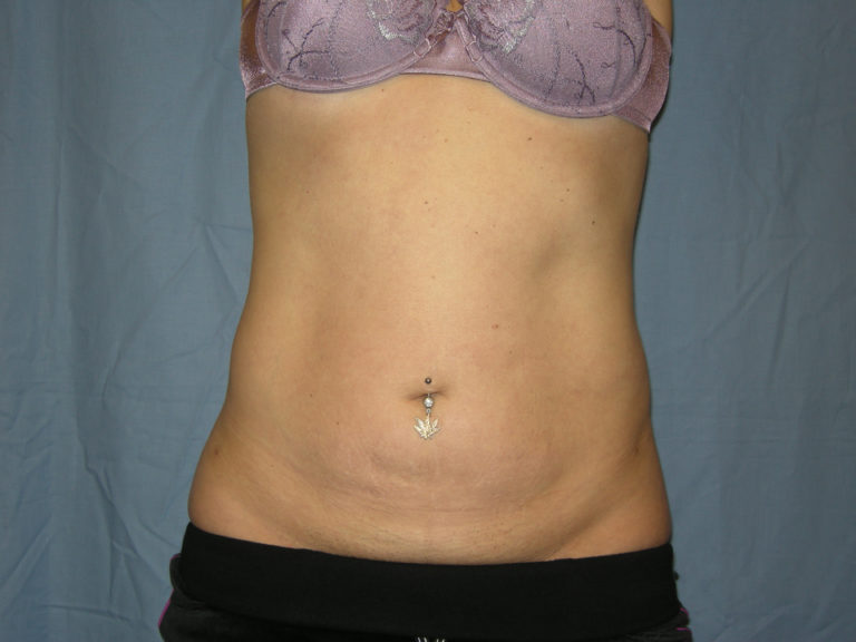 Liposuction - Case 3012 - After