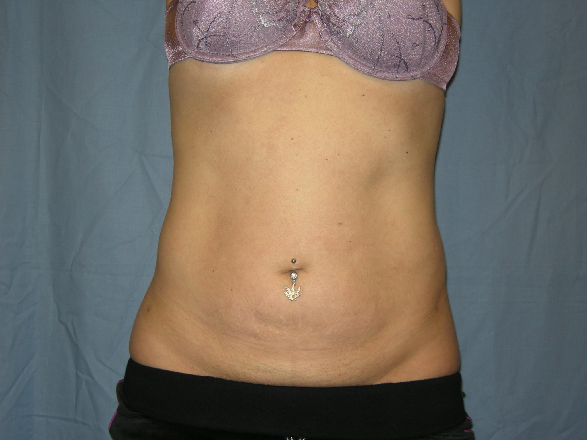 Liposuction Patient Photo - Case 3012 - after view