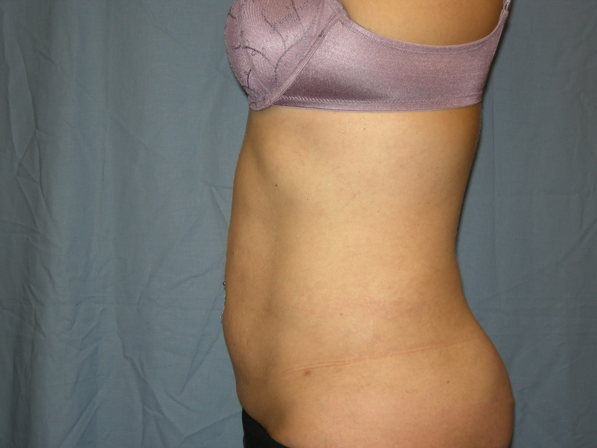 Liposuction Patient Photo - Case 3012 - after view-1