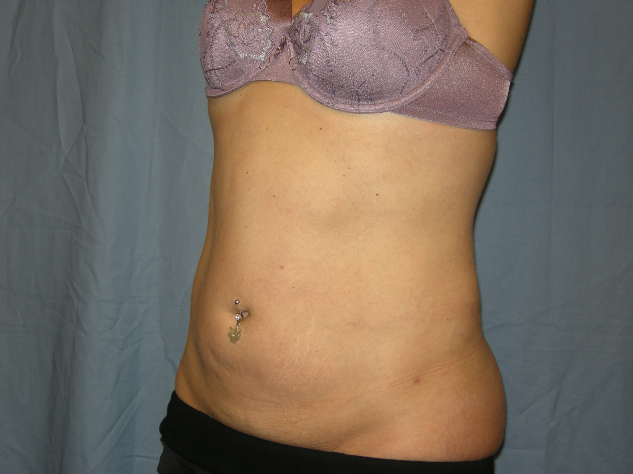 Liposuction Patient Photo - Case 3012 - after view-2