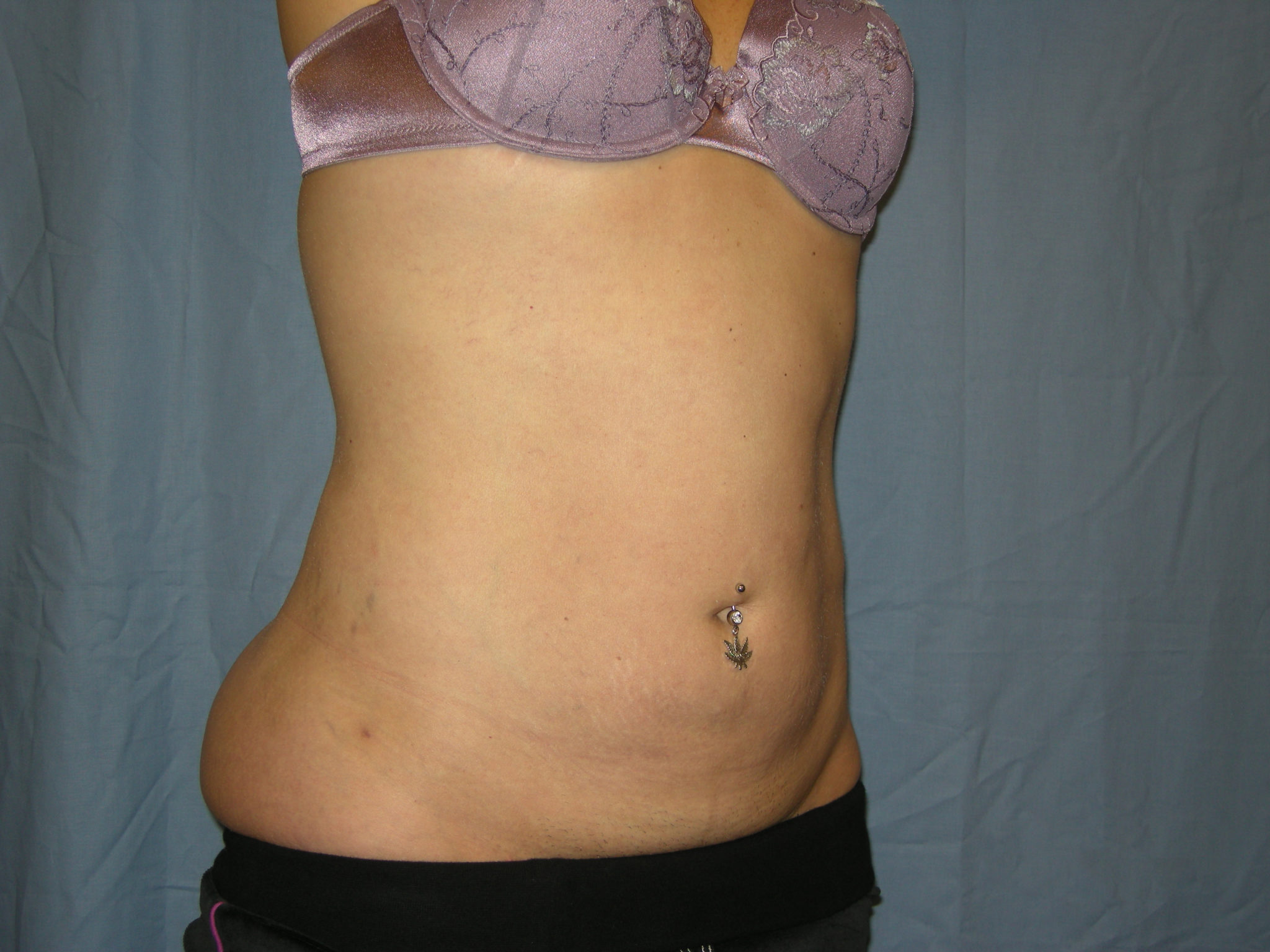 Liposuction Patient Photo - Case 3012 - after view-3