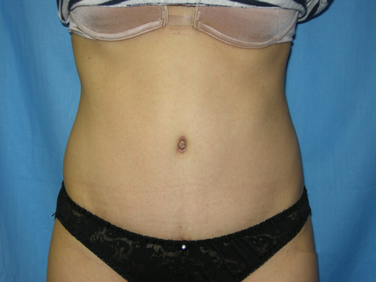 Tummy Tuck - Case 3433 - After