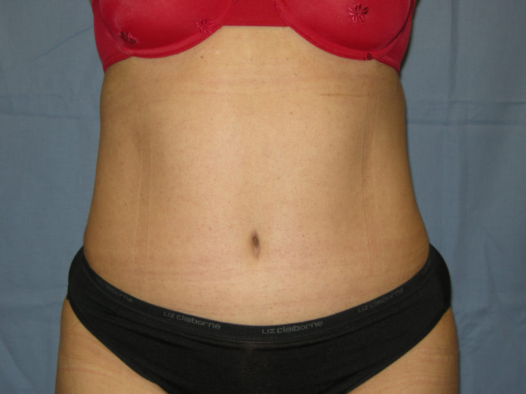 Liposuction - Case 3370 - After