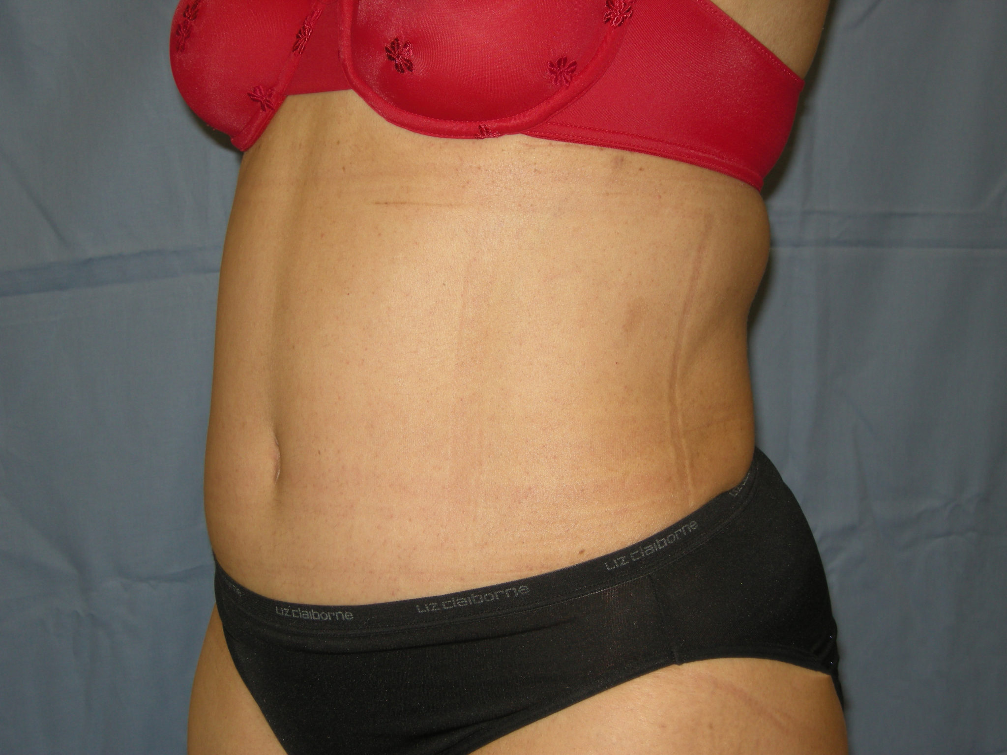 Liposuction Patient Photo - Case 3370 - after view-2