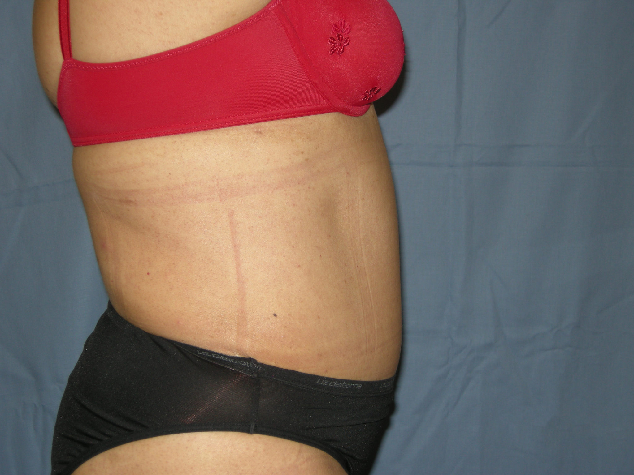 Liposuction Patient Photo - Case 3370 - after view-3