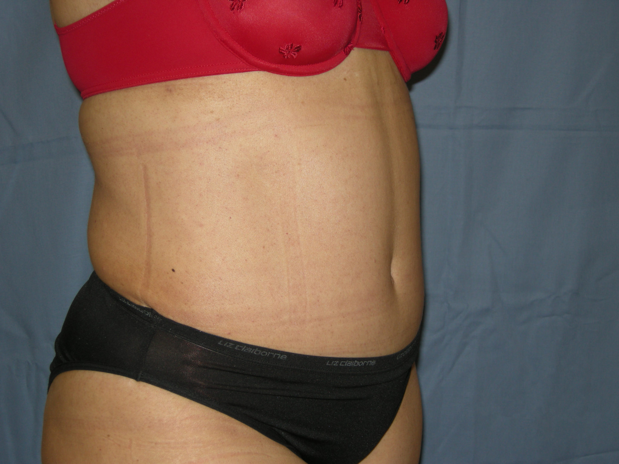Liposuction Patient Photo - Case 3370 - after view-4