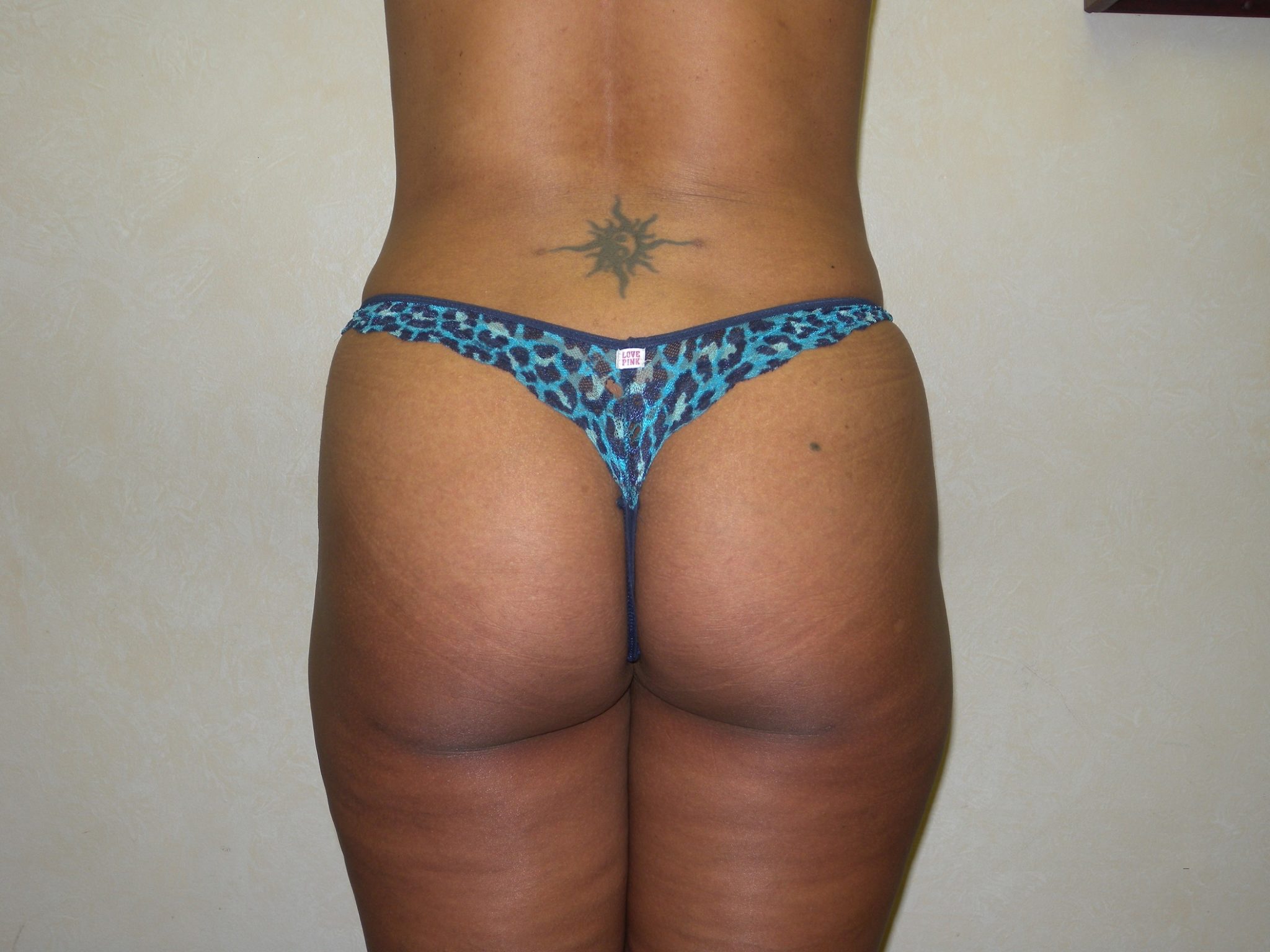 Booty Boost Patient Photo - Case 2987 - after view