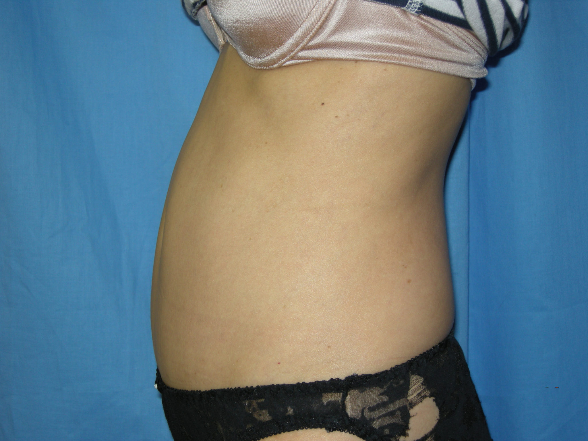 Tummy Tuck Patient Photo - Case 3433 - after view-1