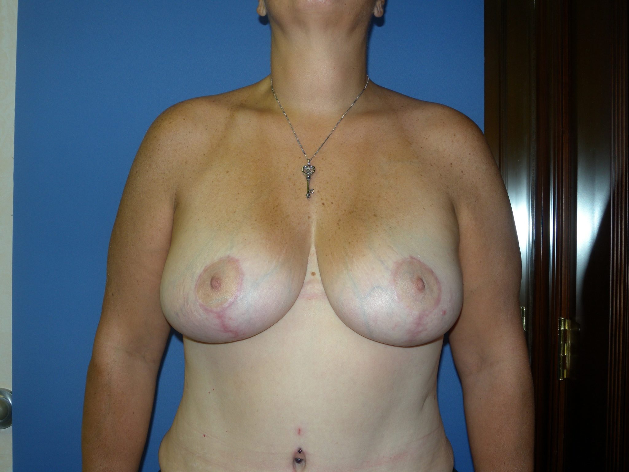 Breast Reduction Patient Photo - Case 4589 - after view