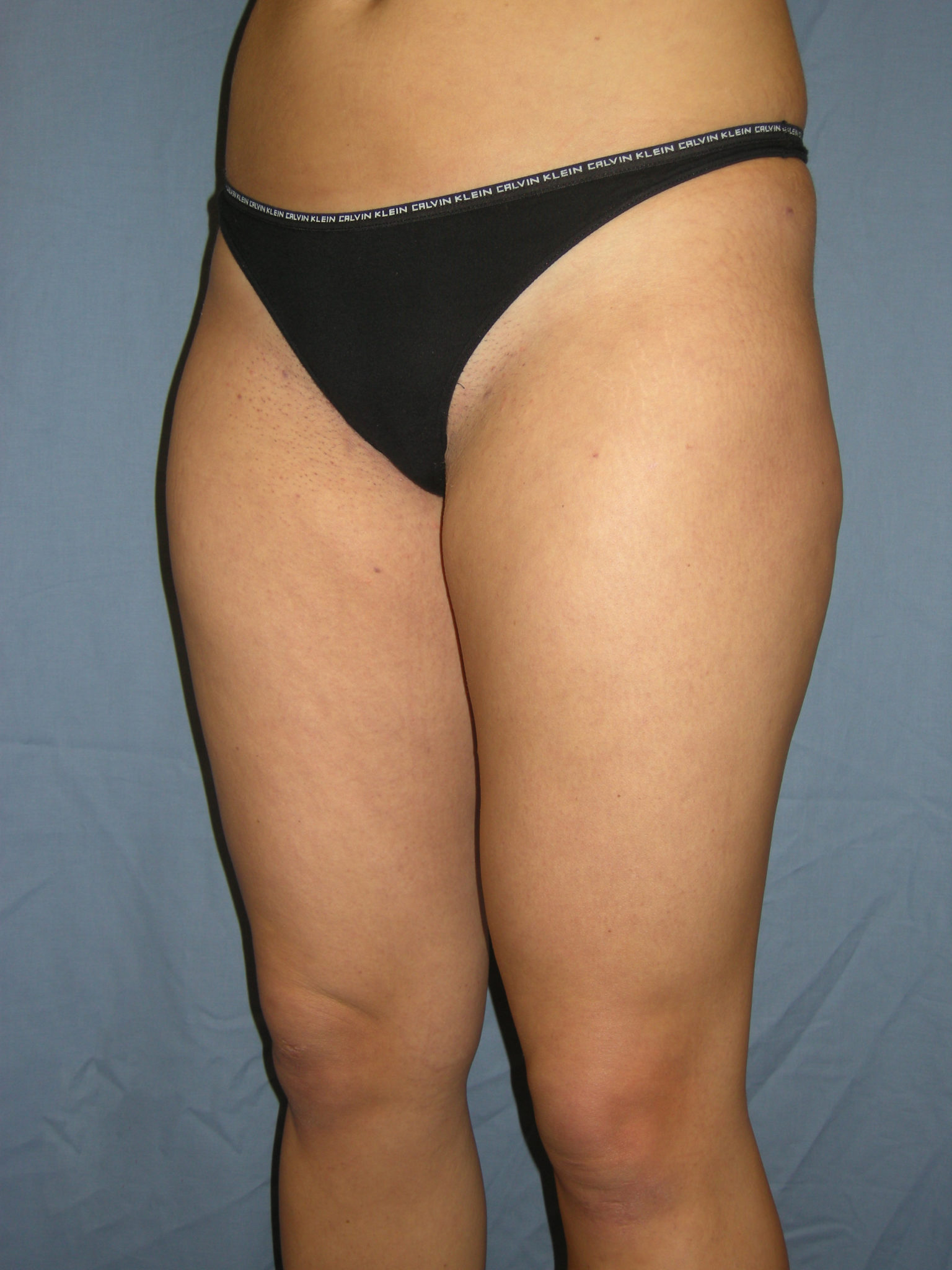 Liposuction Patient Photo - Case 3237 - after view-3