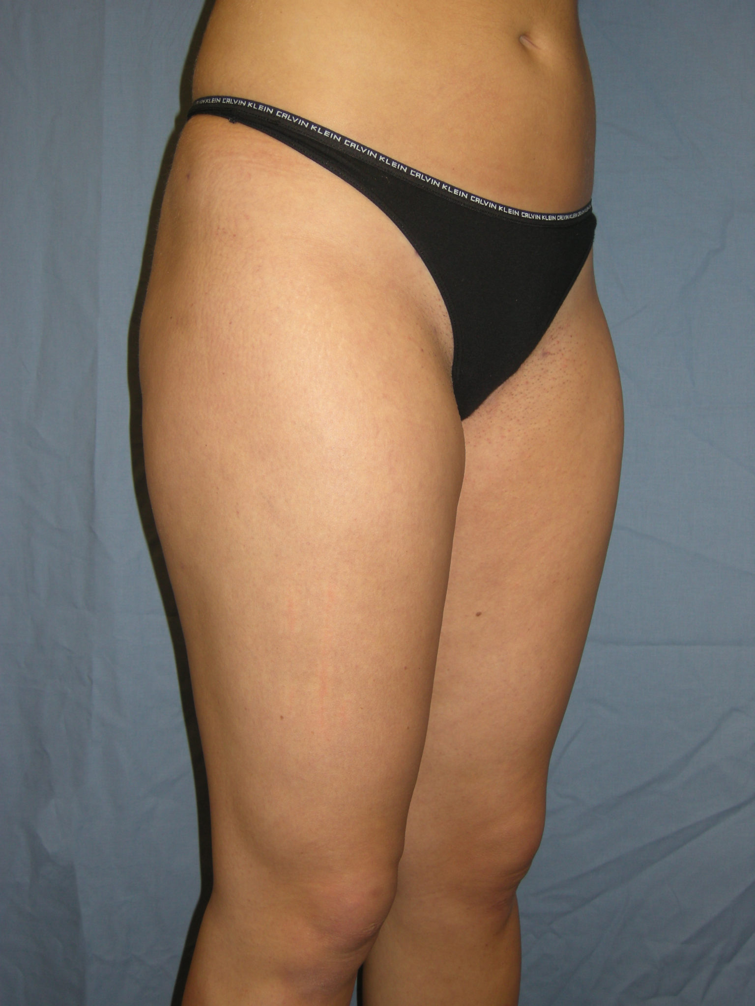 Liposuction Patient Photo - Case 3237 - after view-5