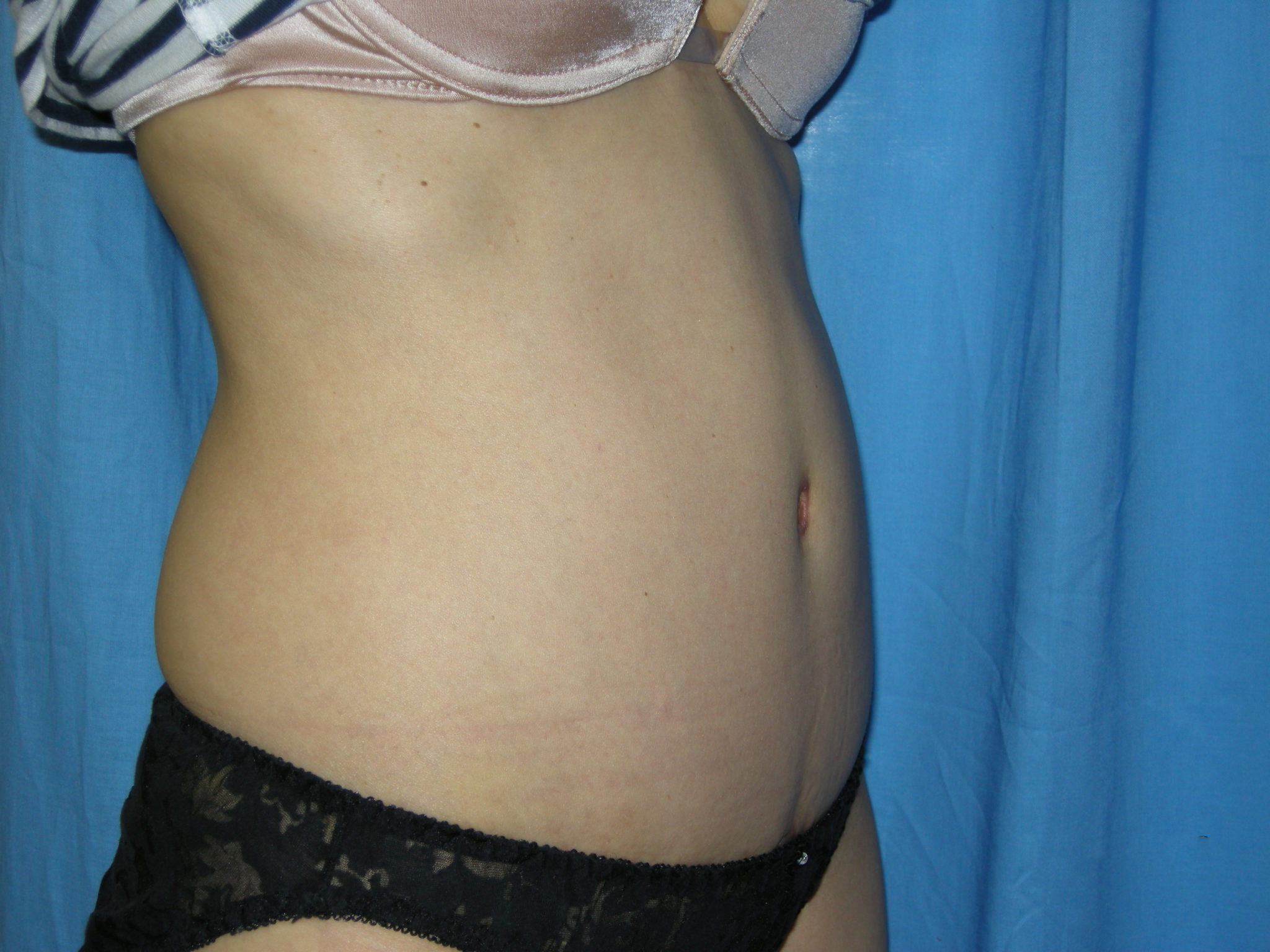 Tummy Tuck Patient Photo - Case 3433 - after view-3