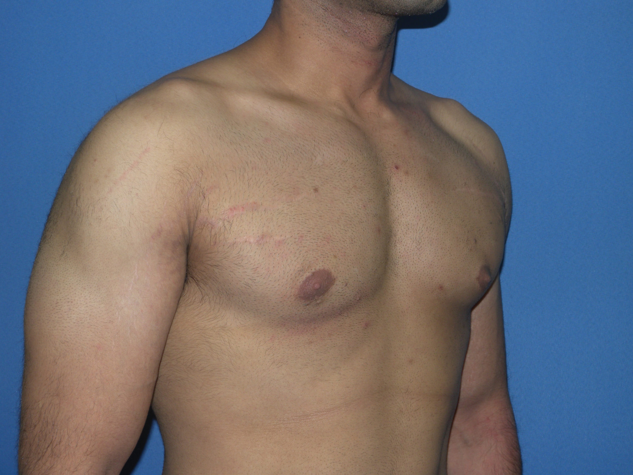 Male Breast Reduction Patient Photo - Case 5042 - after view-4