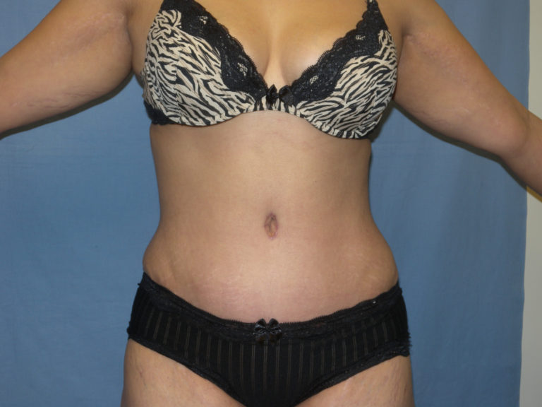 Tummy Tuck - Case 3422 - After