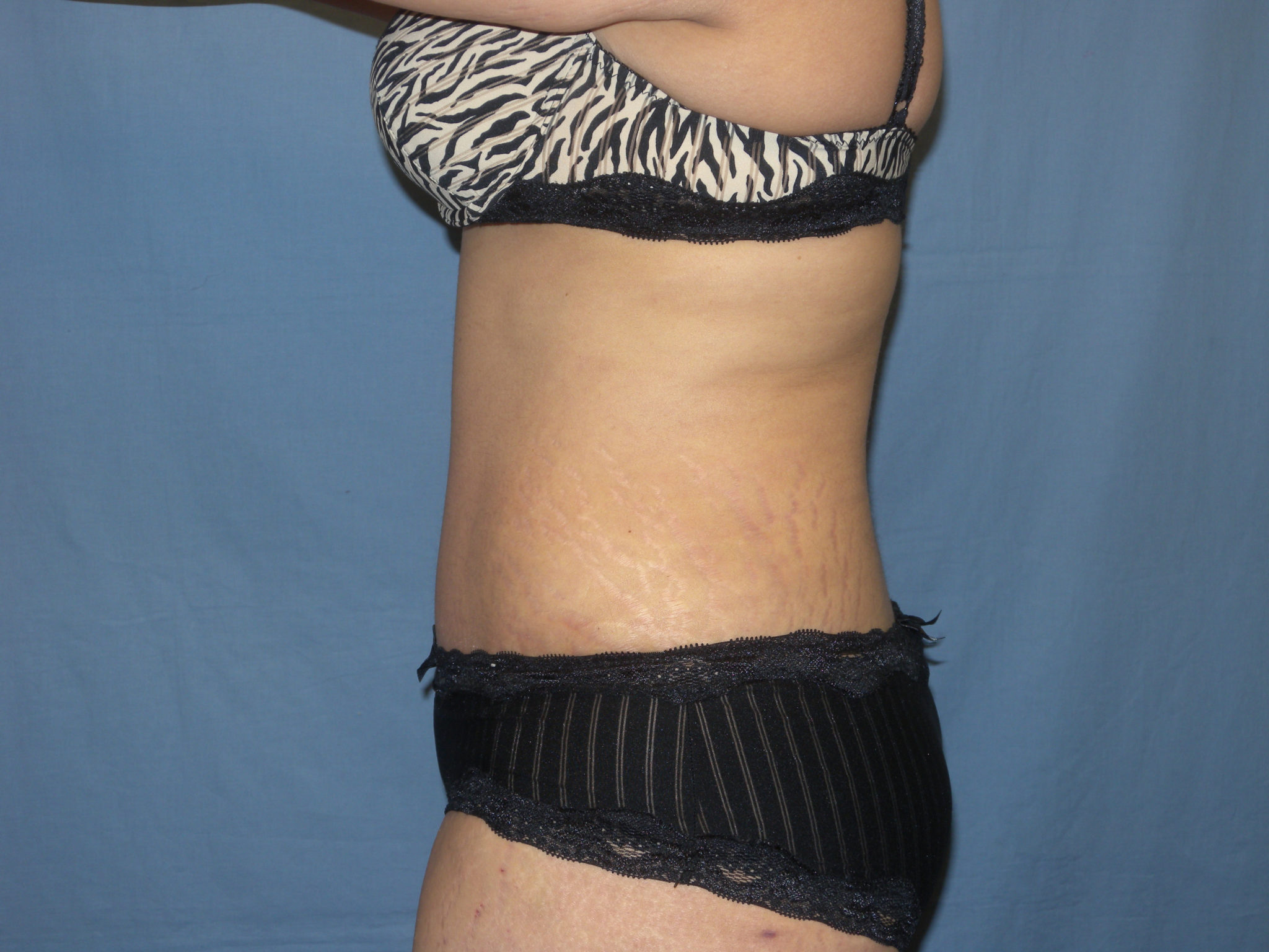 Tummy Tuck Patient Photo - Case 3422 - after view-1