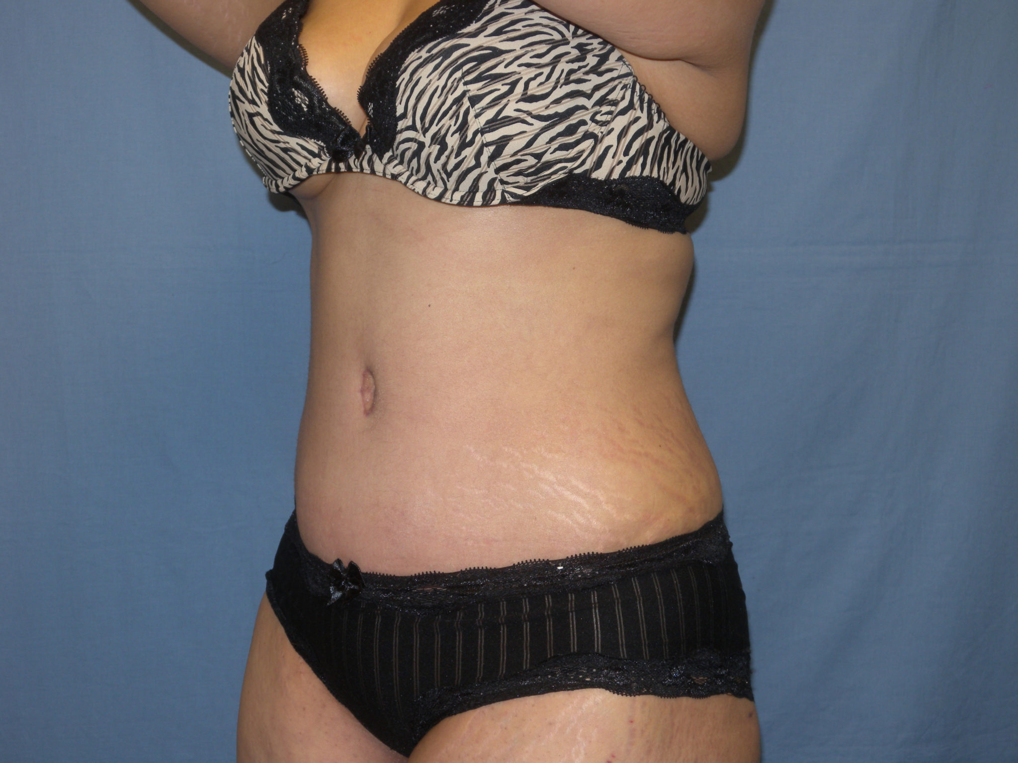 Tummy Tuck Patient Photo - Case 3422 - after view-2