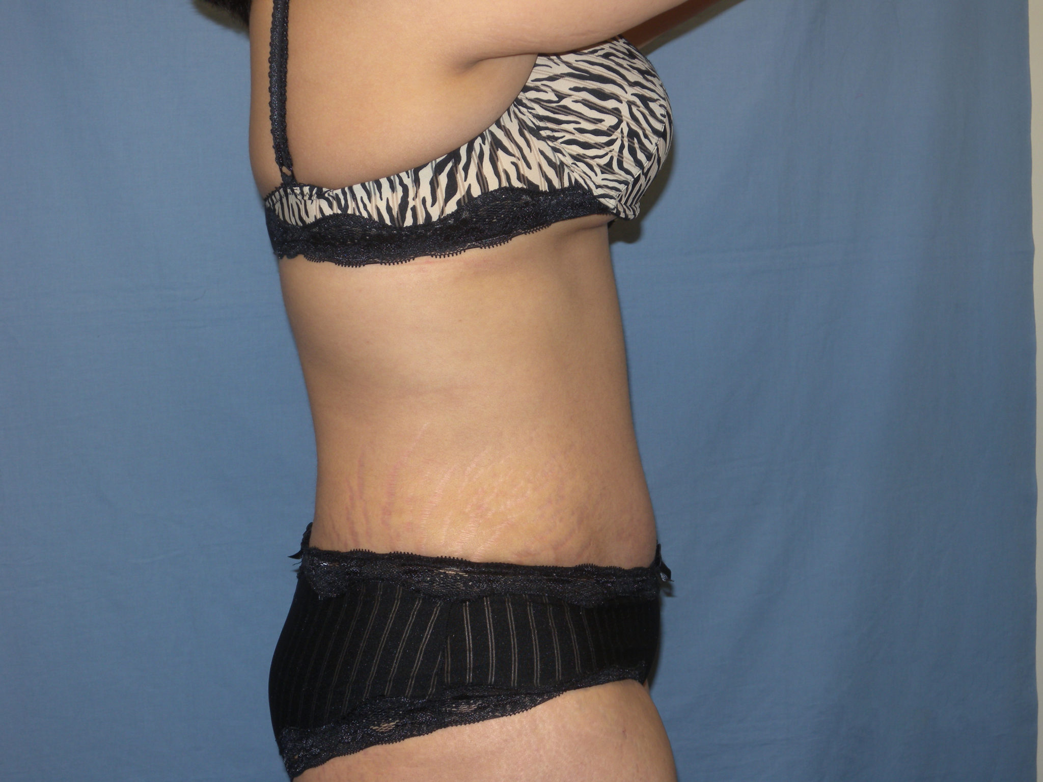 Tummy Tuck Patient Photo - Case 3422 - after view-3