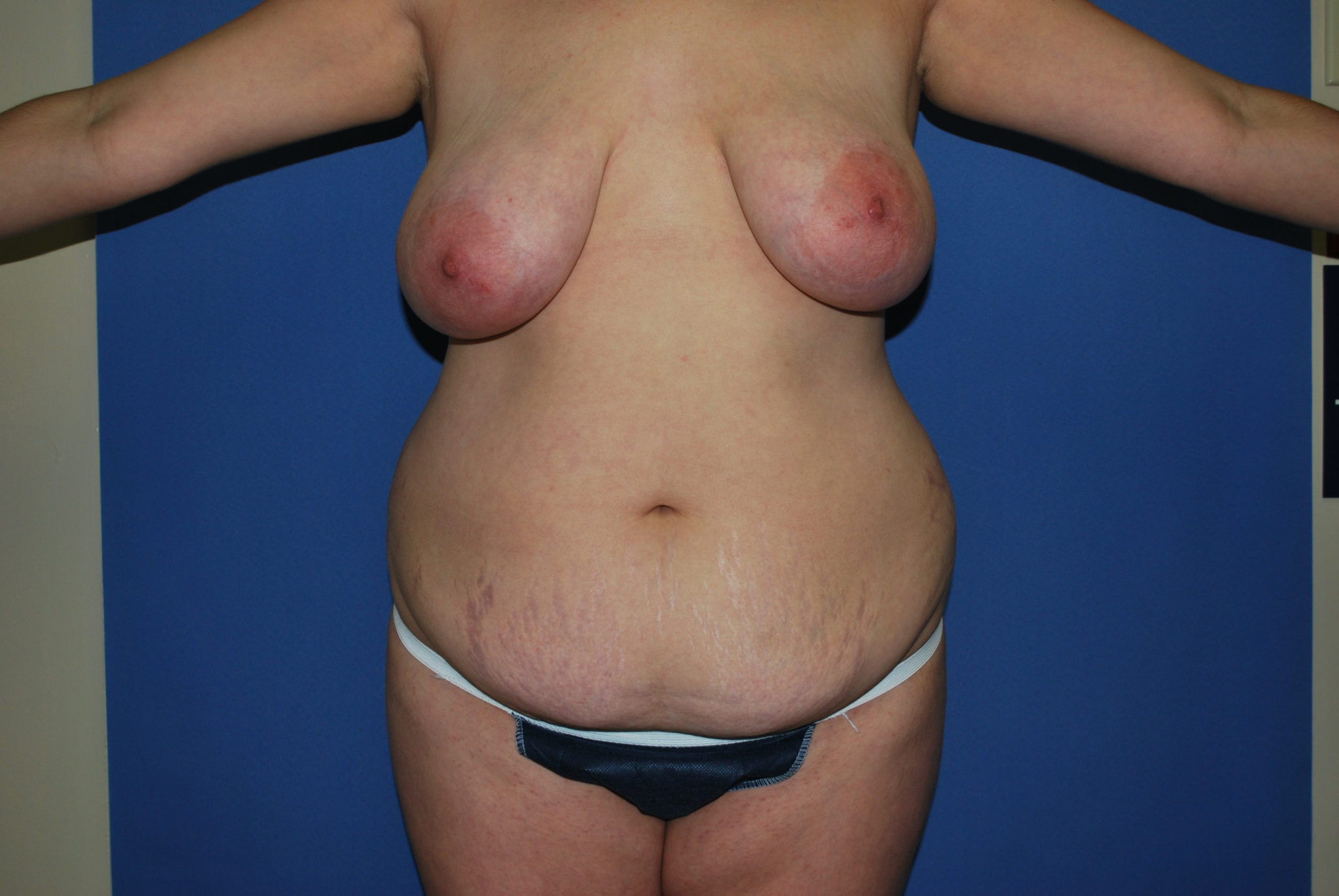 Tummy Tuck Patient Photo - Case 3321 - before view-0