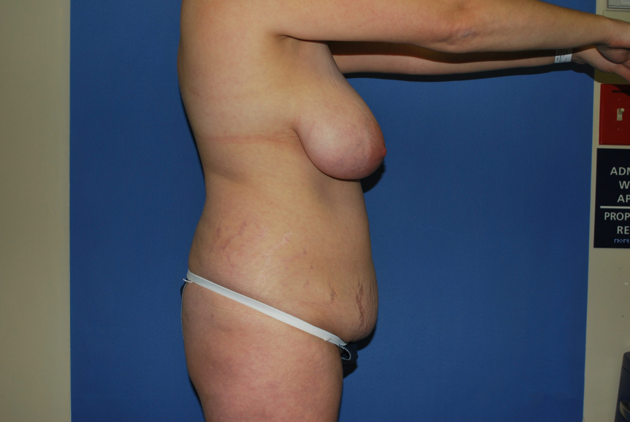 Tummy Tuck Patient Photo - Case 3321 - before view-3