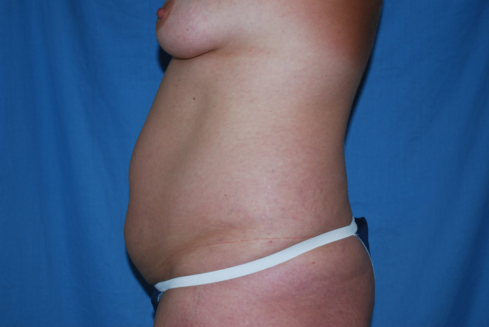 Liposuction Patient Photo - Case 3012 - before view-1