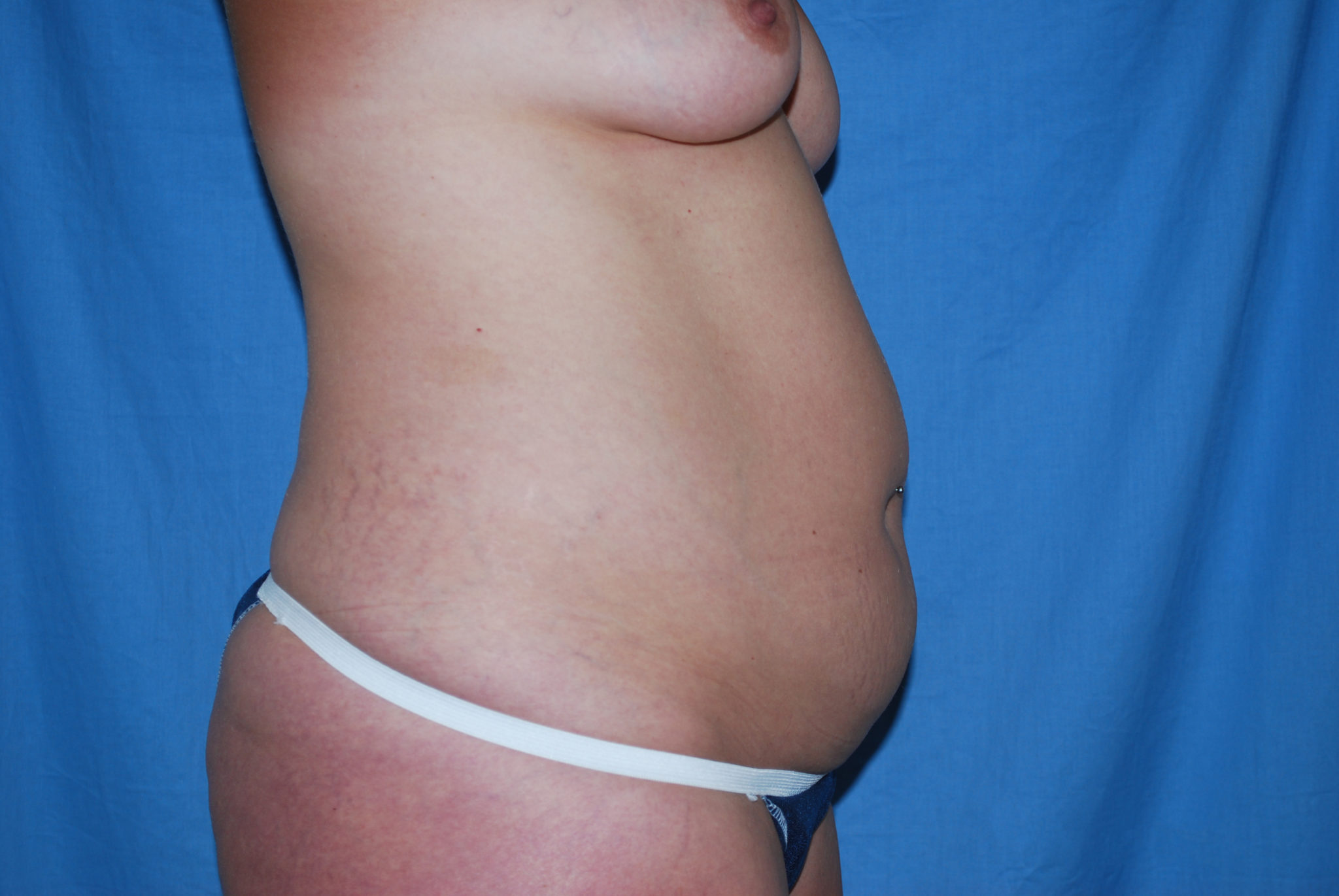 Liposuction Patient Photo - Case 3012 - before view-4