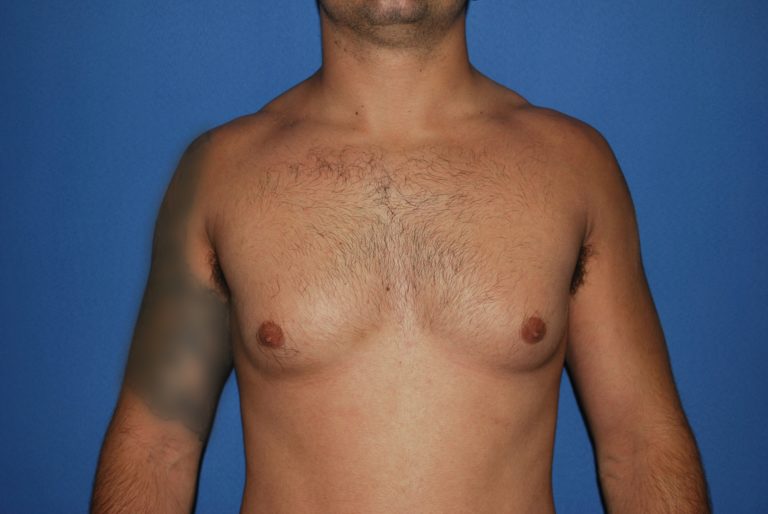 Male Breast Reduction - Case 5024 - Before