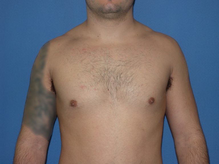 Male Breast Reduction - Case 5024 - After
