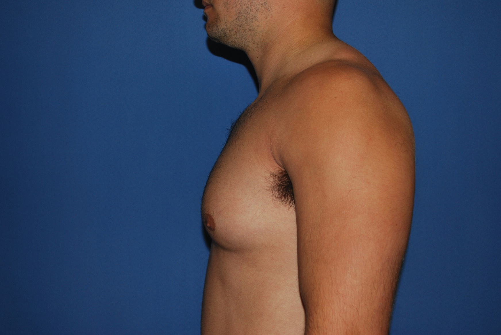 Male Breast Reduction Patient Photo - Case 5024 - before view-1