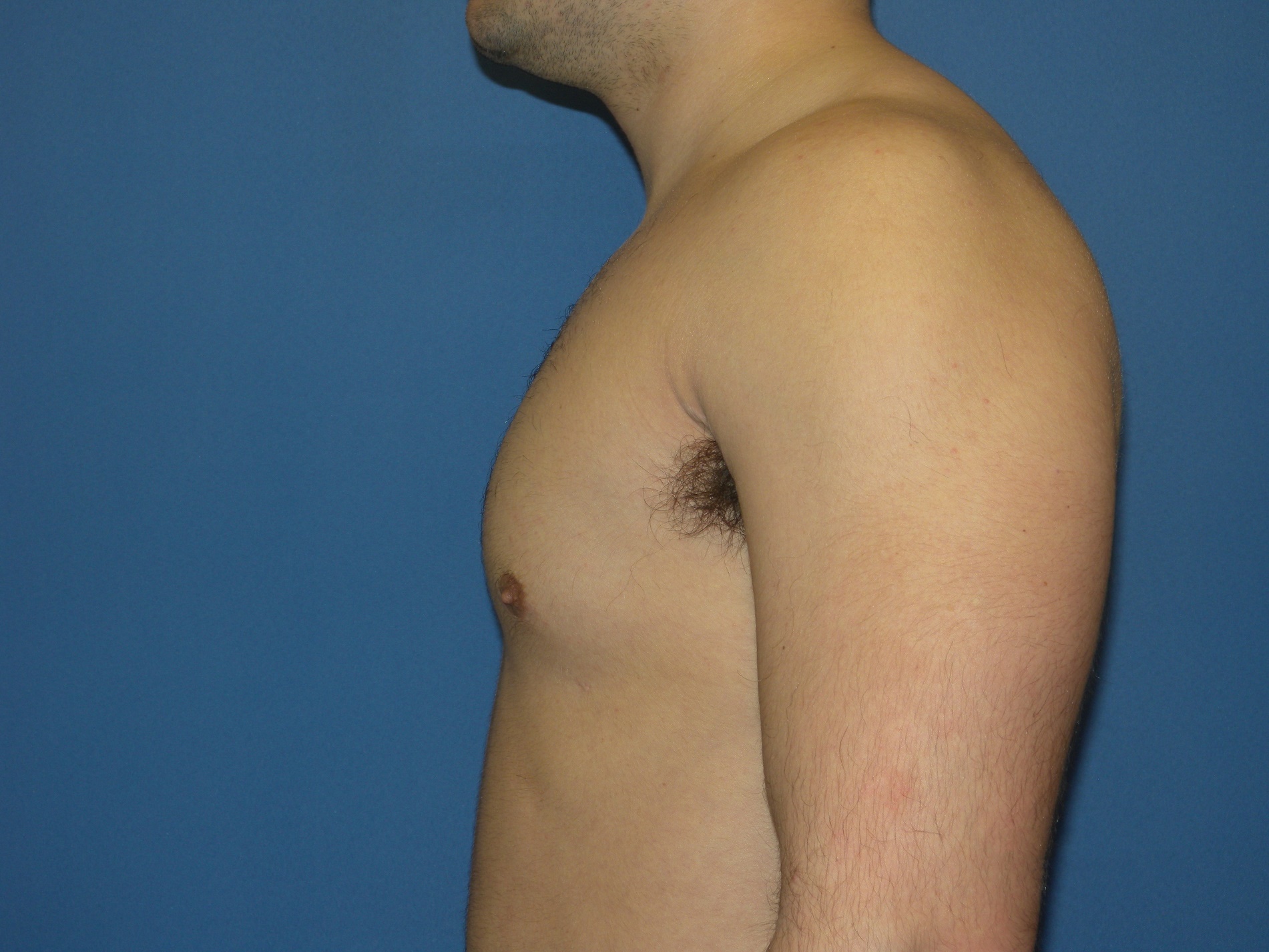 Male Breast Reduction Patient Photo - Case 5024 - after view-1