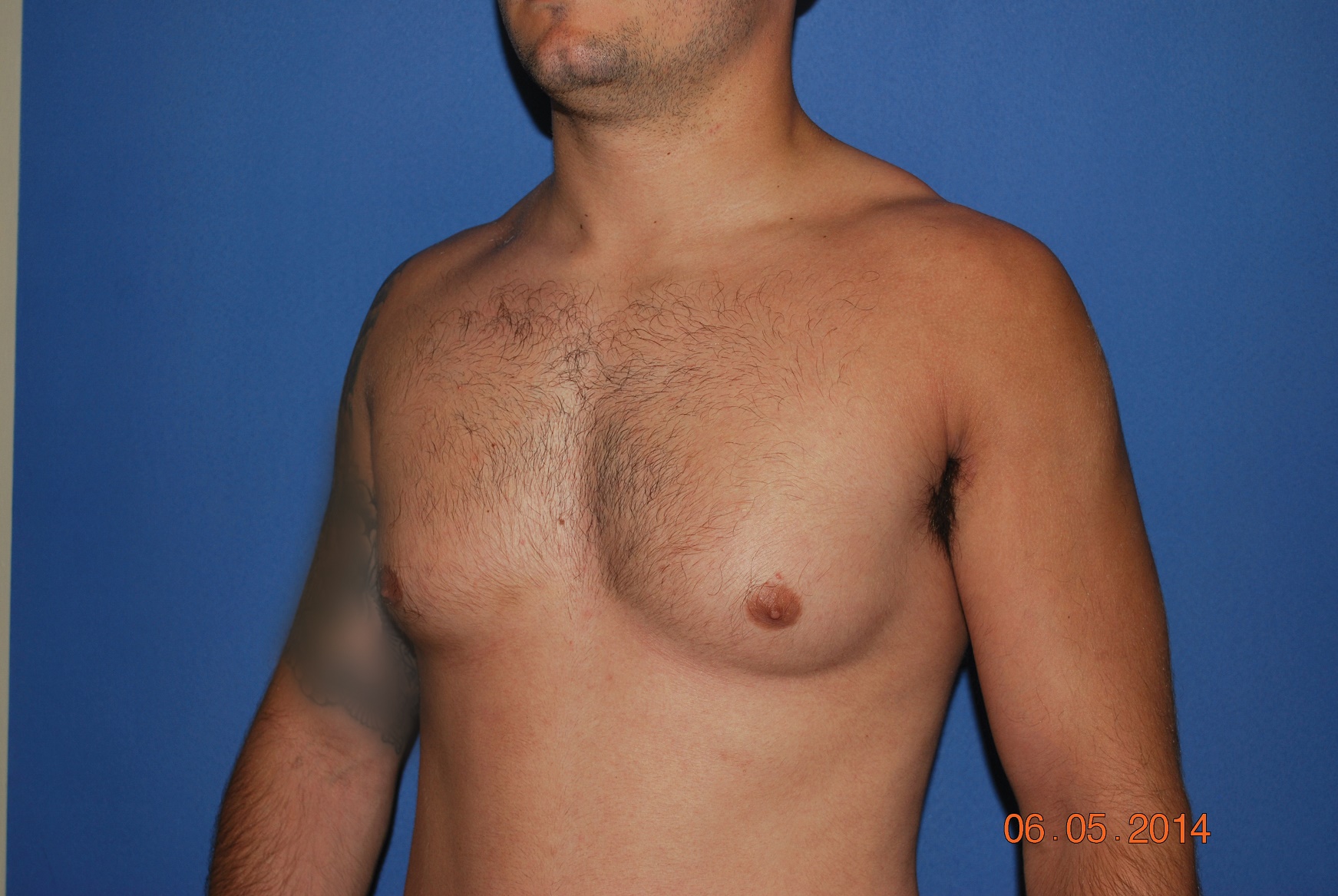 Male Breast Reduction Patient Photo - Case 5024 - before view-2