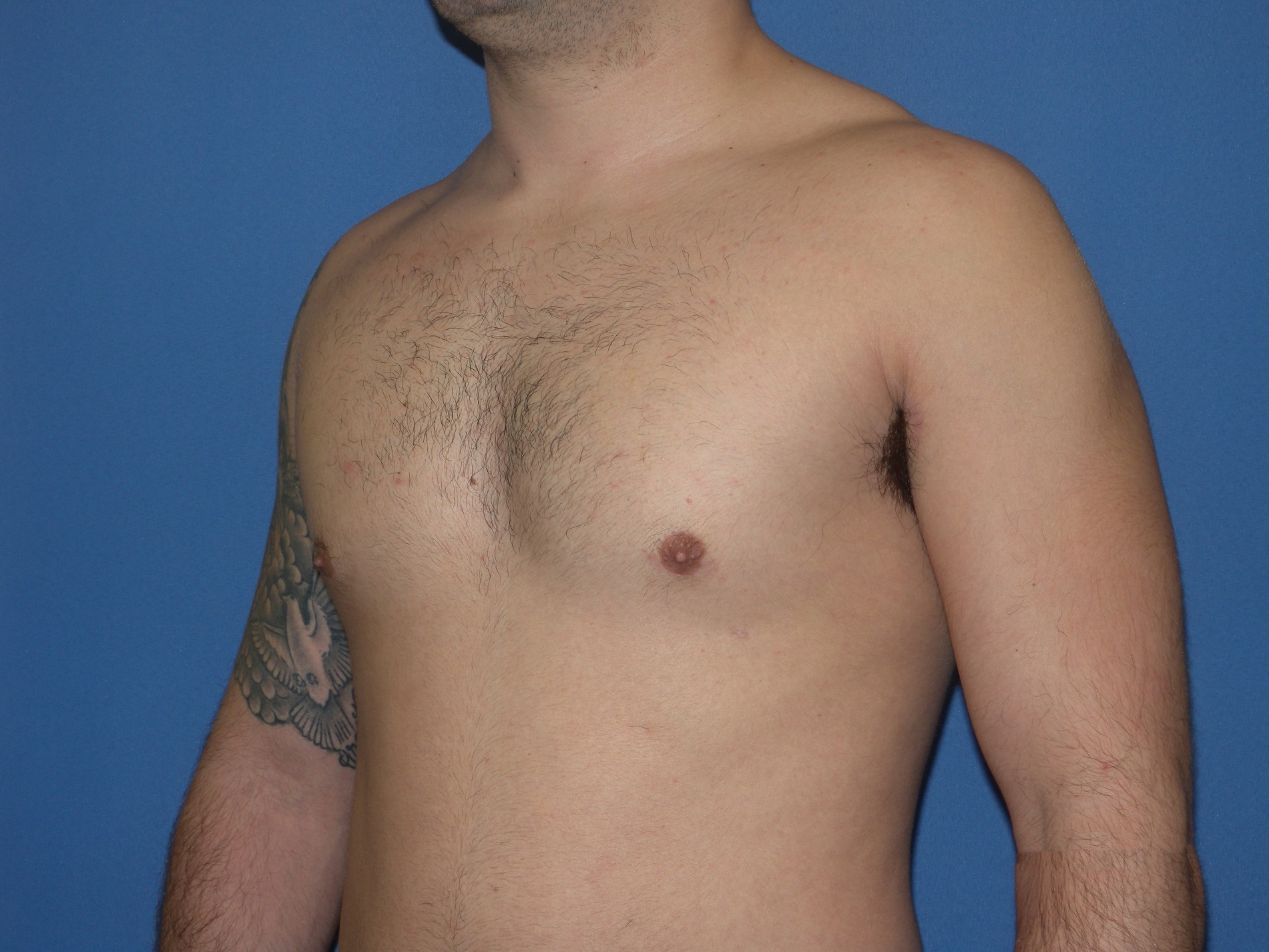 Male Breast Reduction Patient Photo - Case 5024 - after view-2