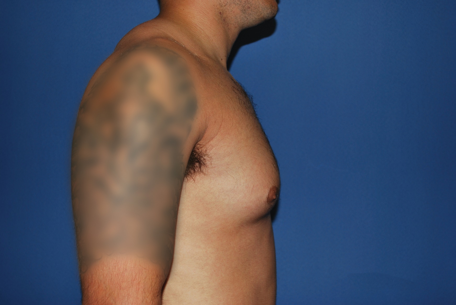 Male Breast Reduction Patient Photo - Case 5024 - before view-3