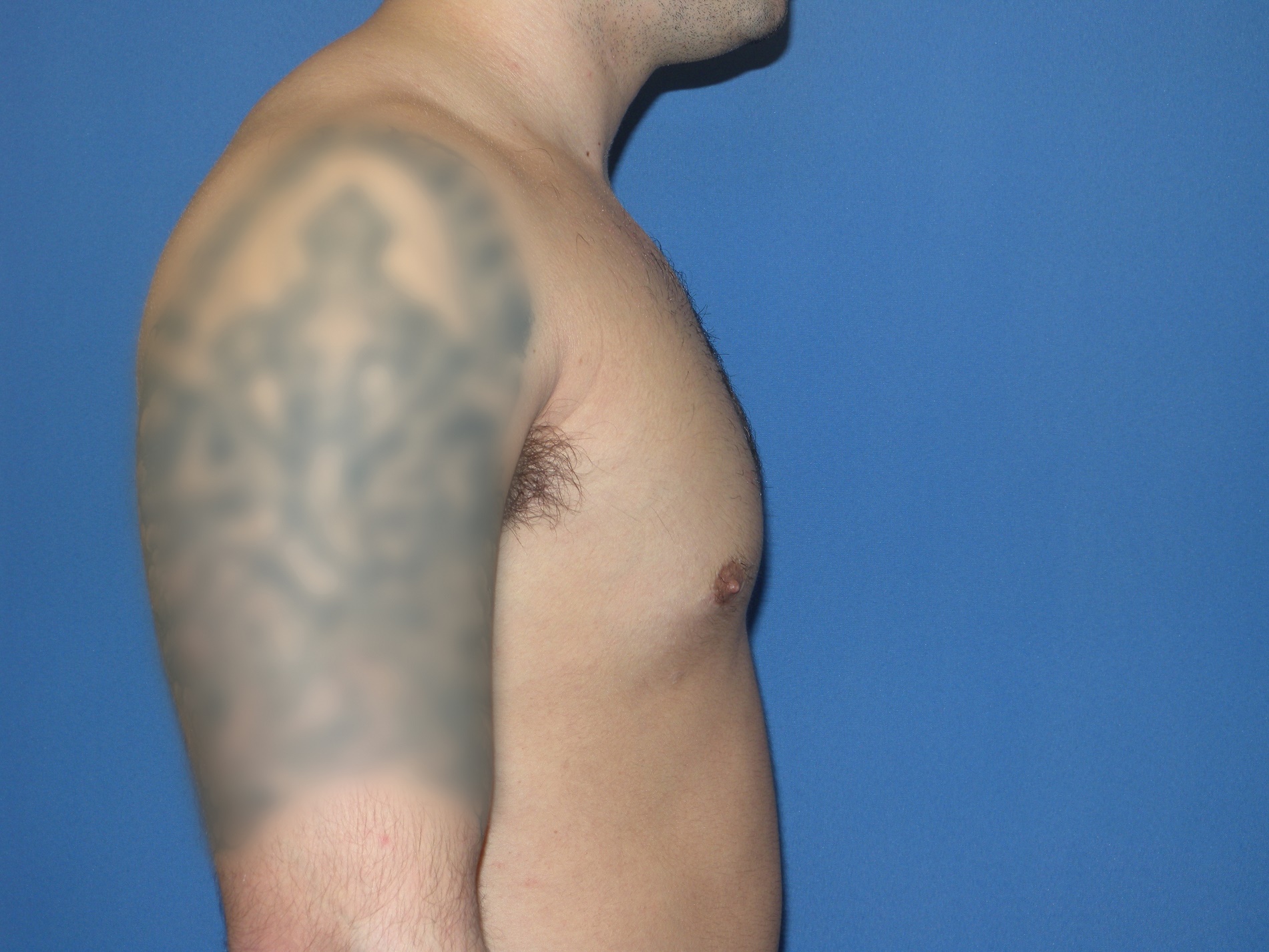 Male Breast Reduction Patient Photo - Case 5024 - after view-3
