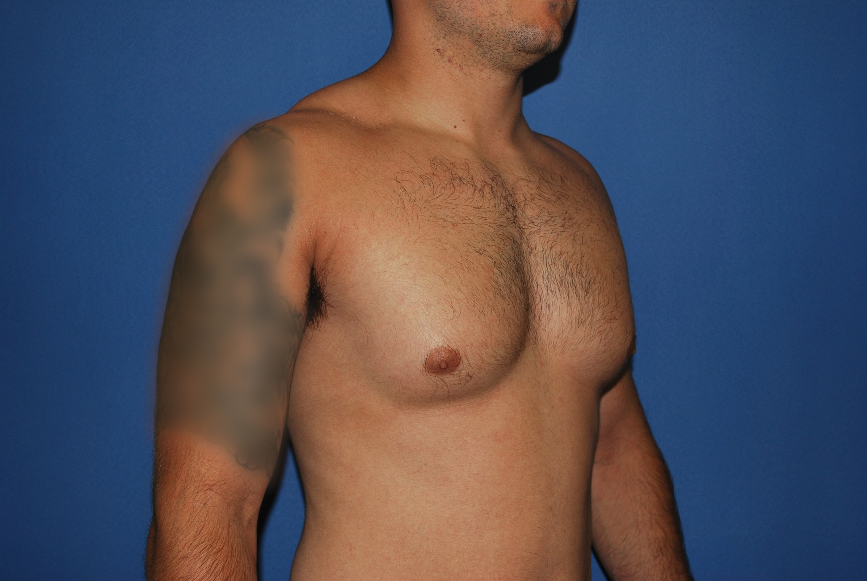 Male Breast Reduction Patient Photo - Case 5024 - before view-4