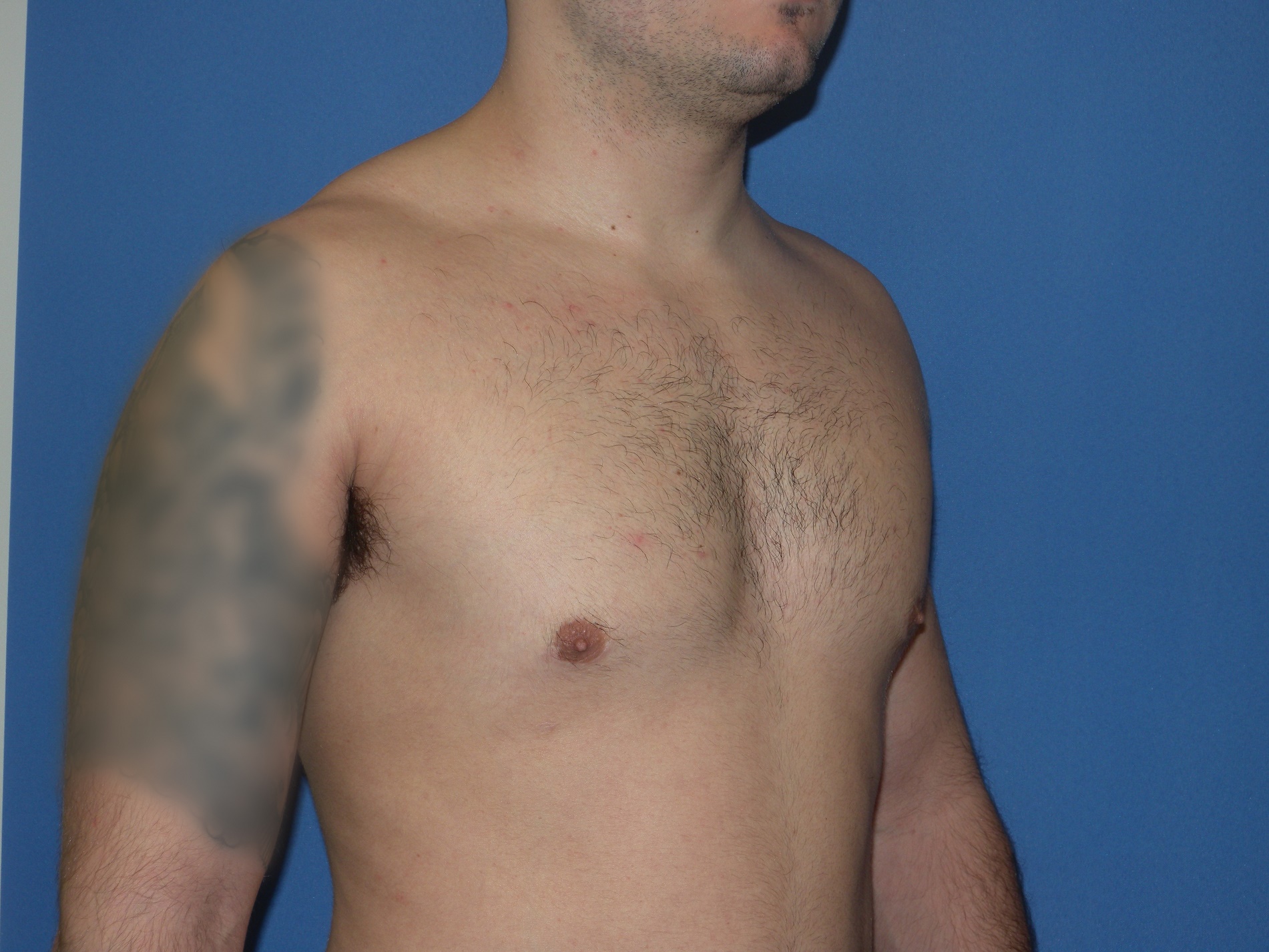 Male Breast Reduction Patient Photo - Case 5024 - after view-4