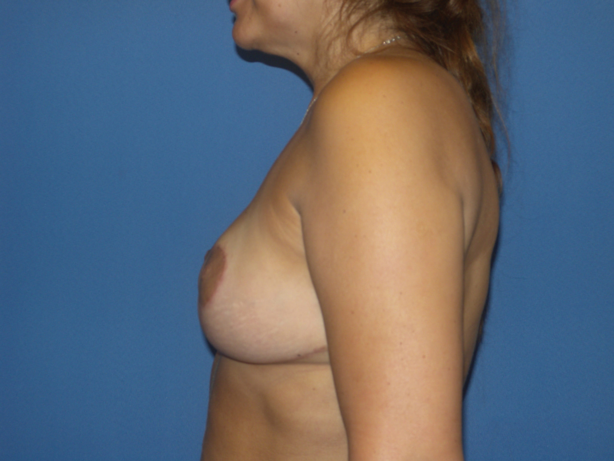 Breast Reduction Patient Photo - Case 4538 - after view-3