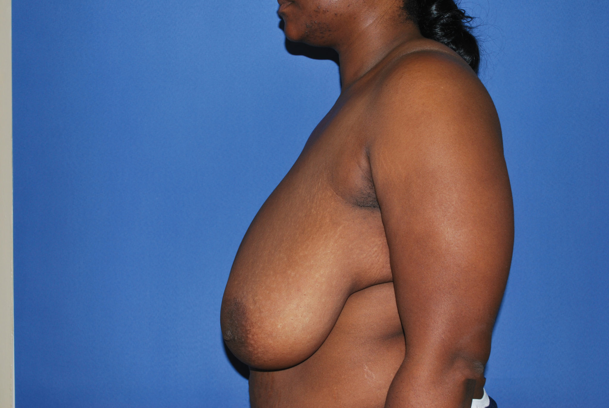 Breast Reduction Patient Photo - Case 4581 - before view-4