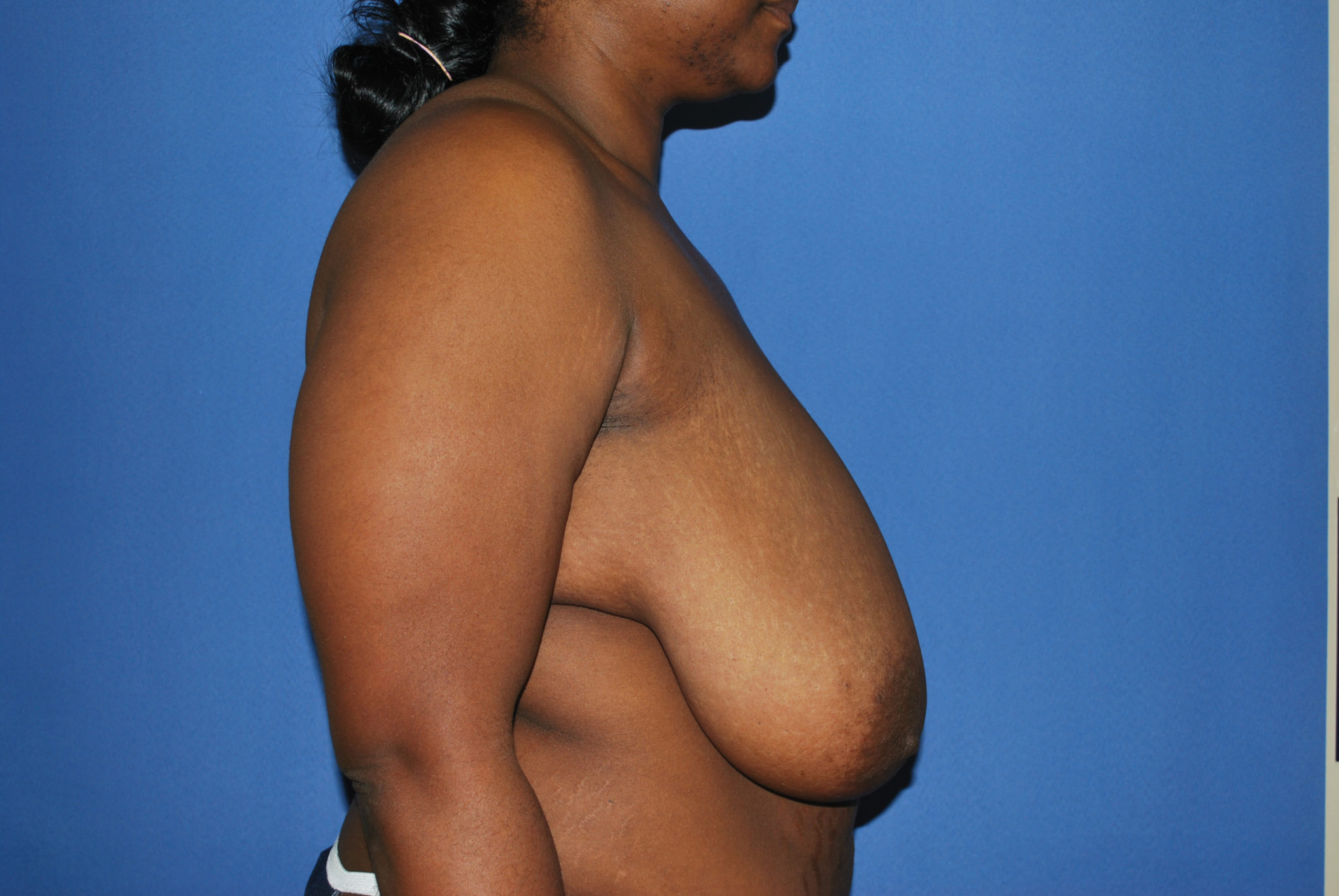 Breast Reduction Patient Photo - Case 4581 - before view-1
