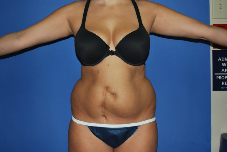 Liposuction - Case 3046 - Before