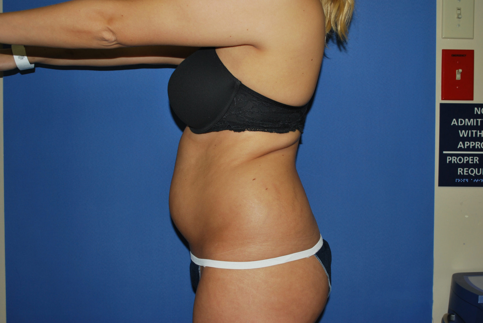 Liposuction Patient Photo - Case 3046 - before view-1