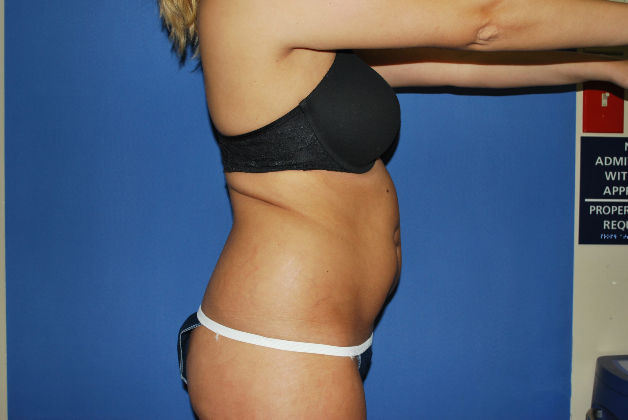Liposuction Patient Photo - Case 3046 - before view-3