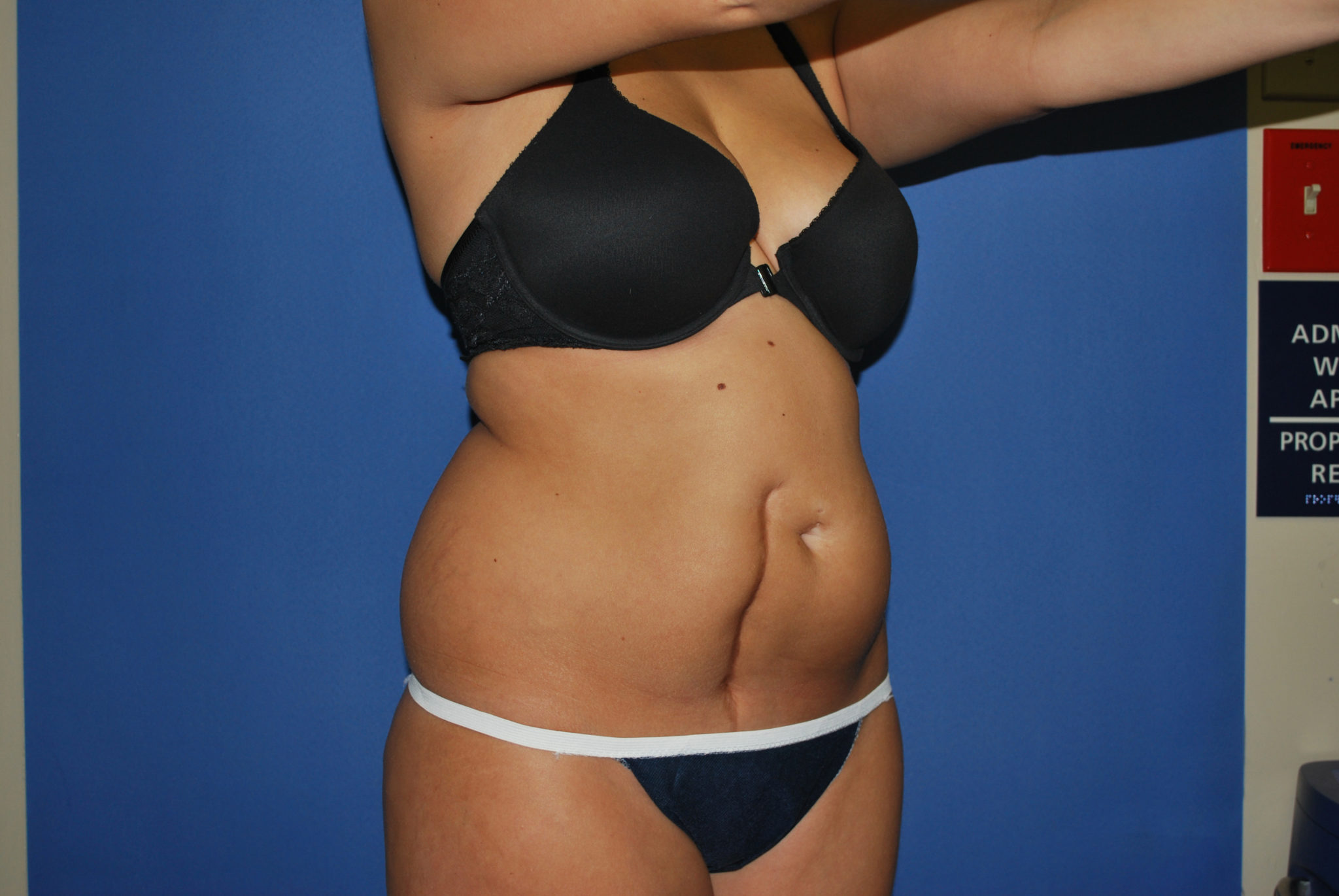 Liposuction Patient Photo - Case 3046 - before view-4