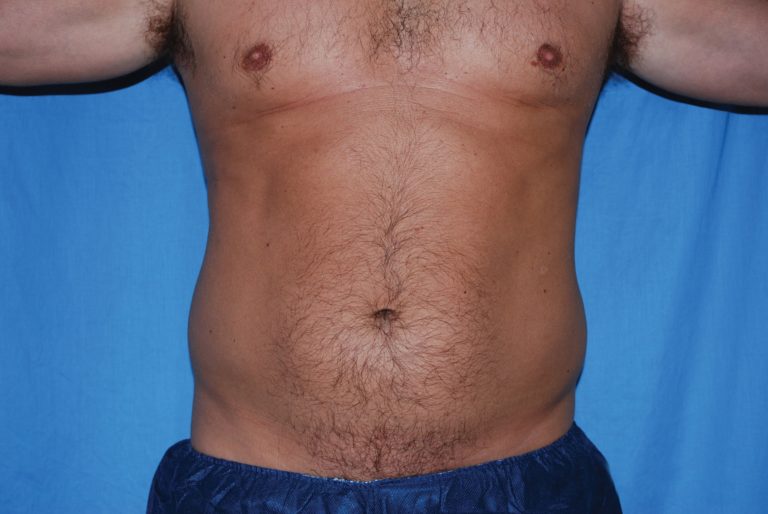 Liposuction - Case 4725 - Before