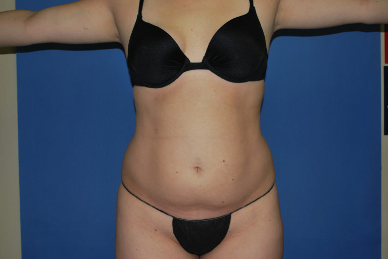 Liposuction - Case 3068 - Before