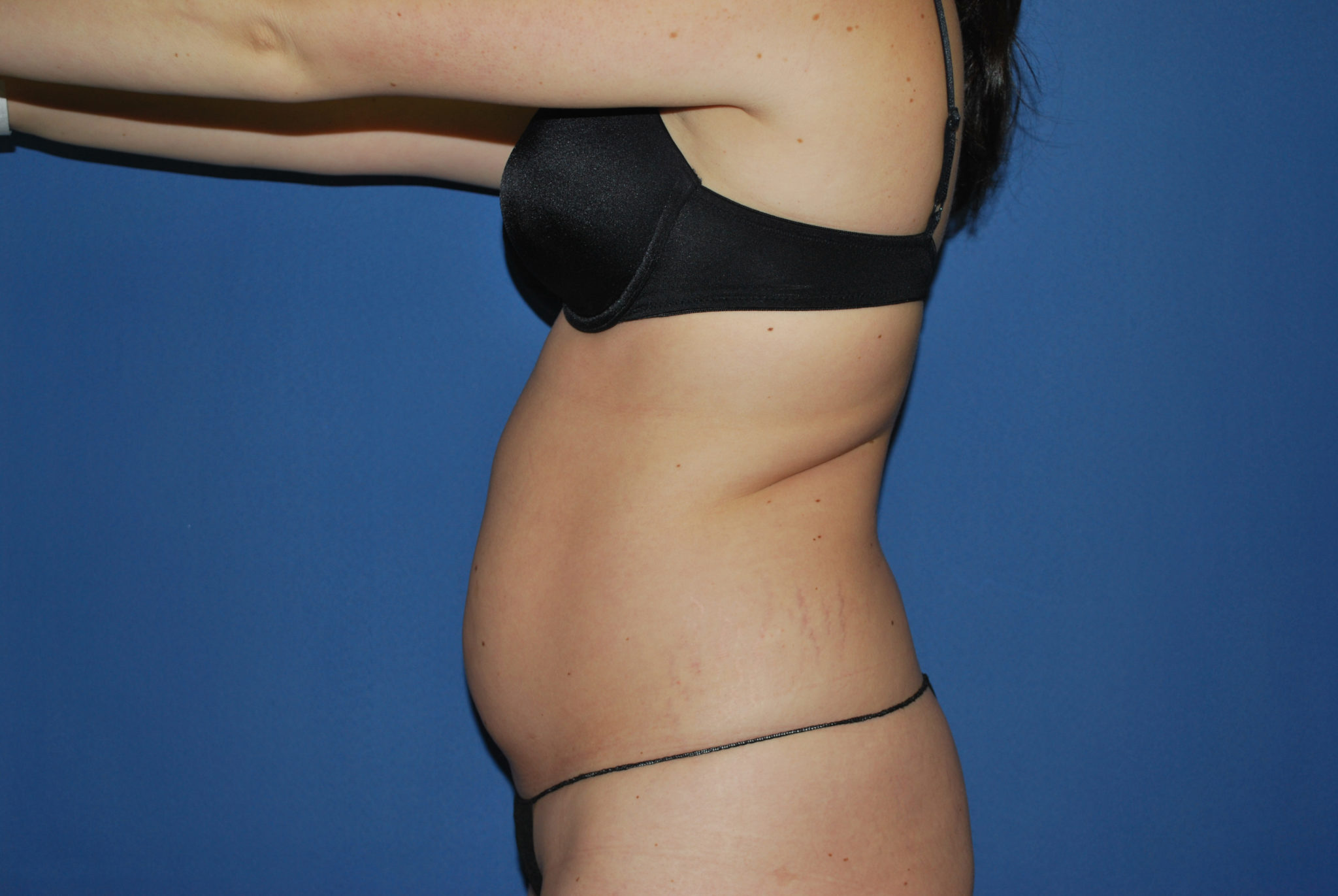 Liposuction Patient Photo - Case 3068 - before view-1