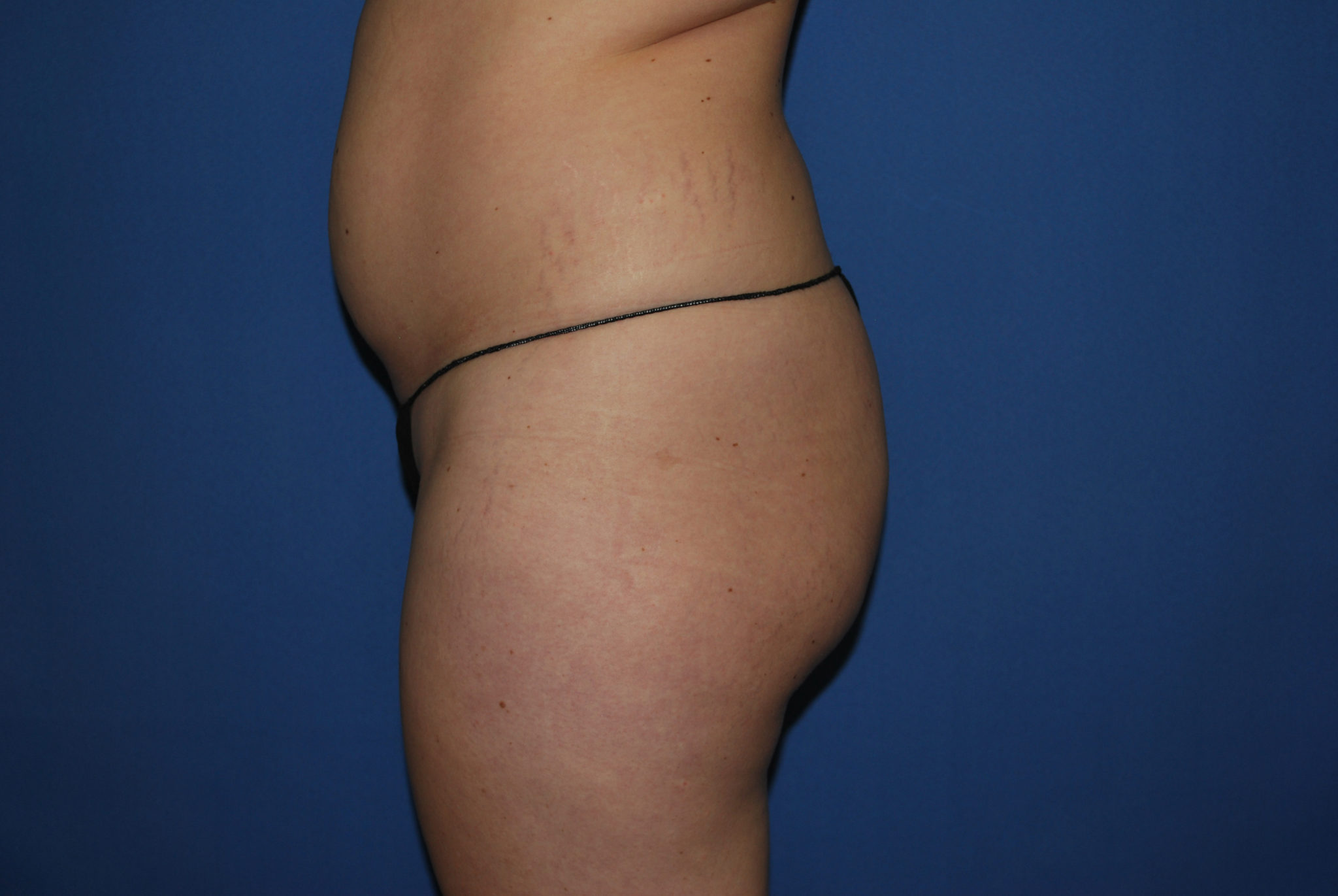 Liposuction Patient Photo - Case 3068 - before view-2