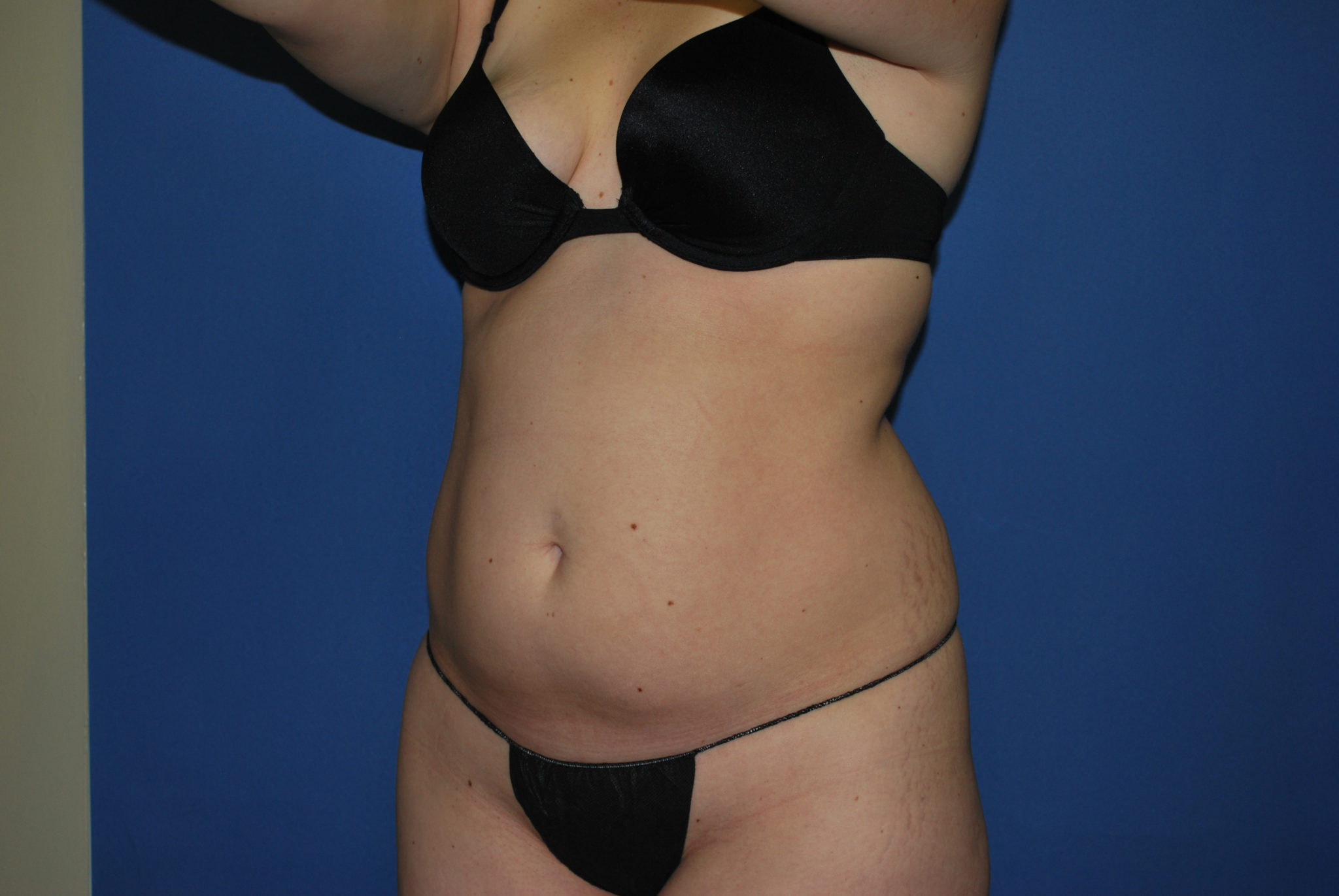 Liposuction Patient Photo - Case 3068 - before view-3