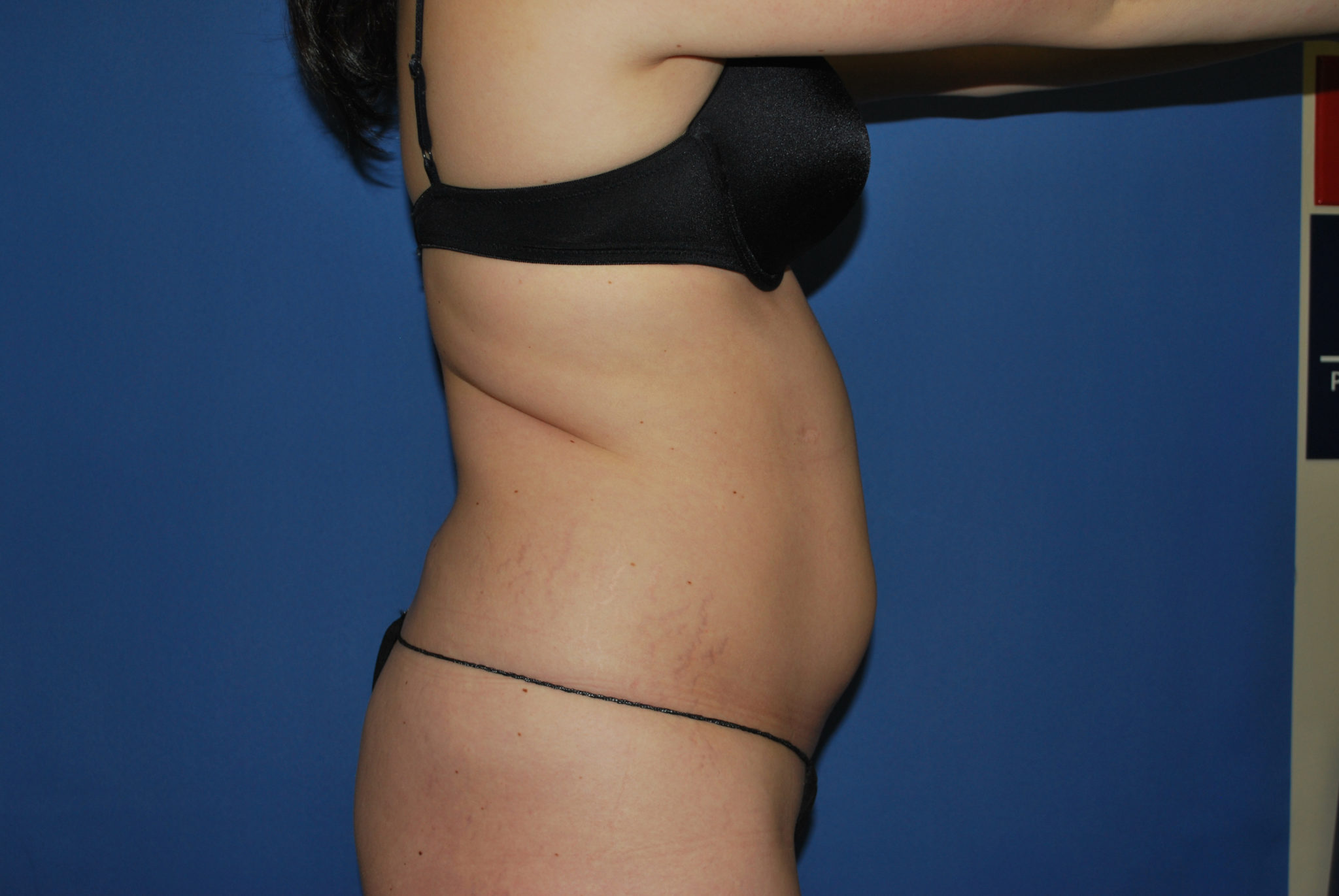 Liposuction Patient Photo - Case 3068 - before view-4