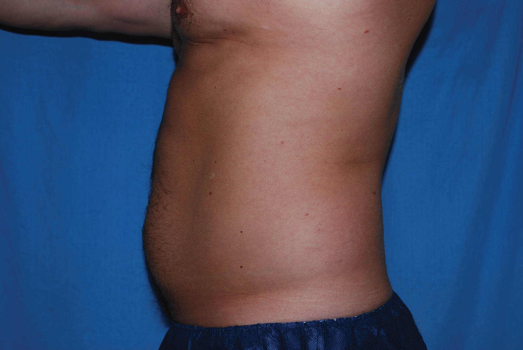 Liposuction Patient Photo - Case 4725 - before view-1