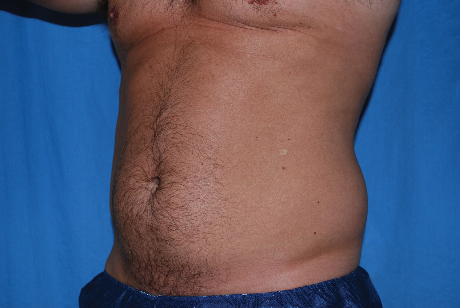 Liposuction Patient Photo - Case 4725 - before view-3